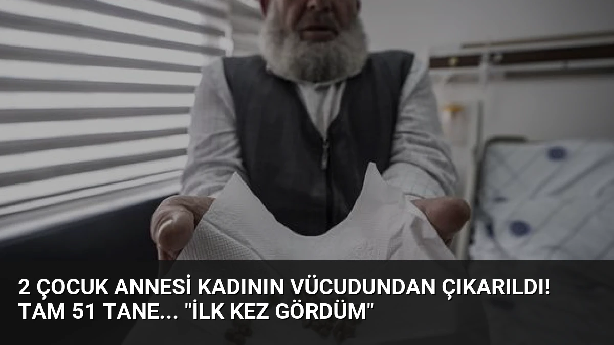 2 çocuk annesi kadının vücudundan çıkarıldı! Tam 51 tane… “İlk kez gördüm”