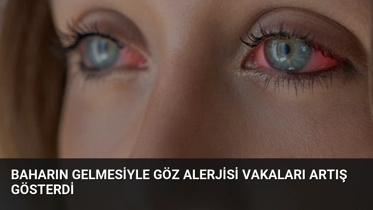 Baharın Gelmesiyle Göz Alerjisi Vakaları Artış Gösterdi