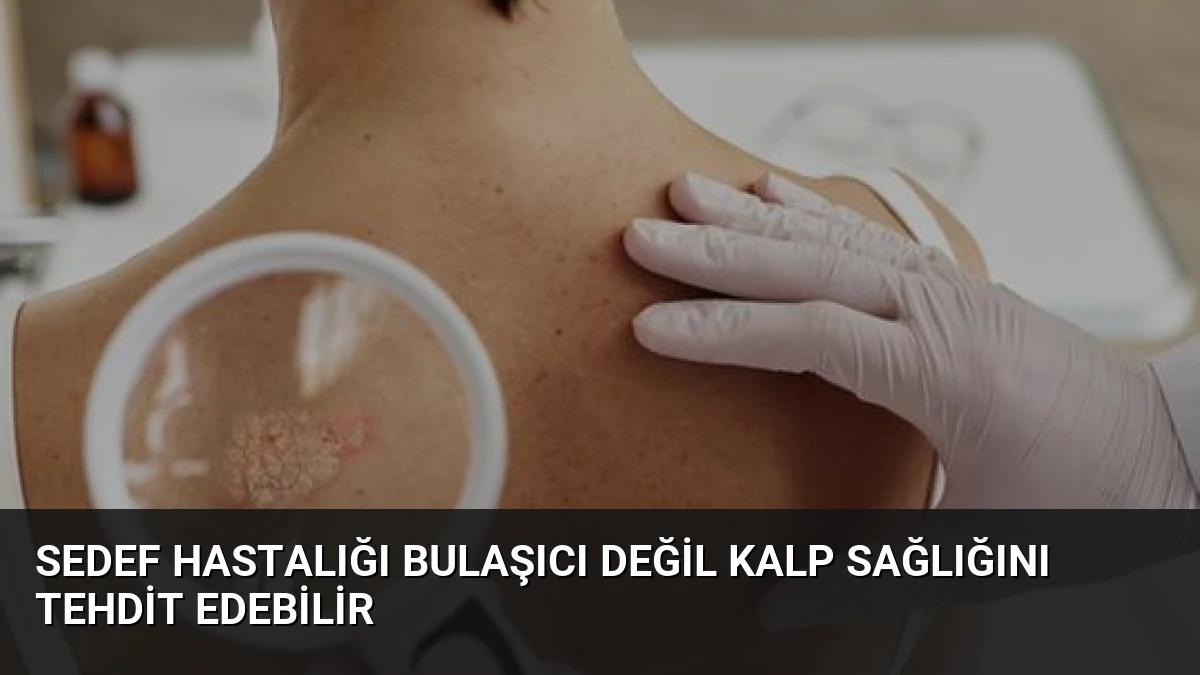 Sedef Hastalığı Bulaşıcı Değil Kalp Sağlığını Tehdit Edebilir