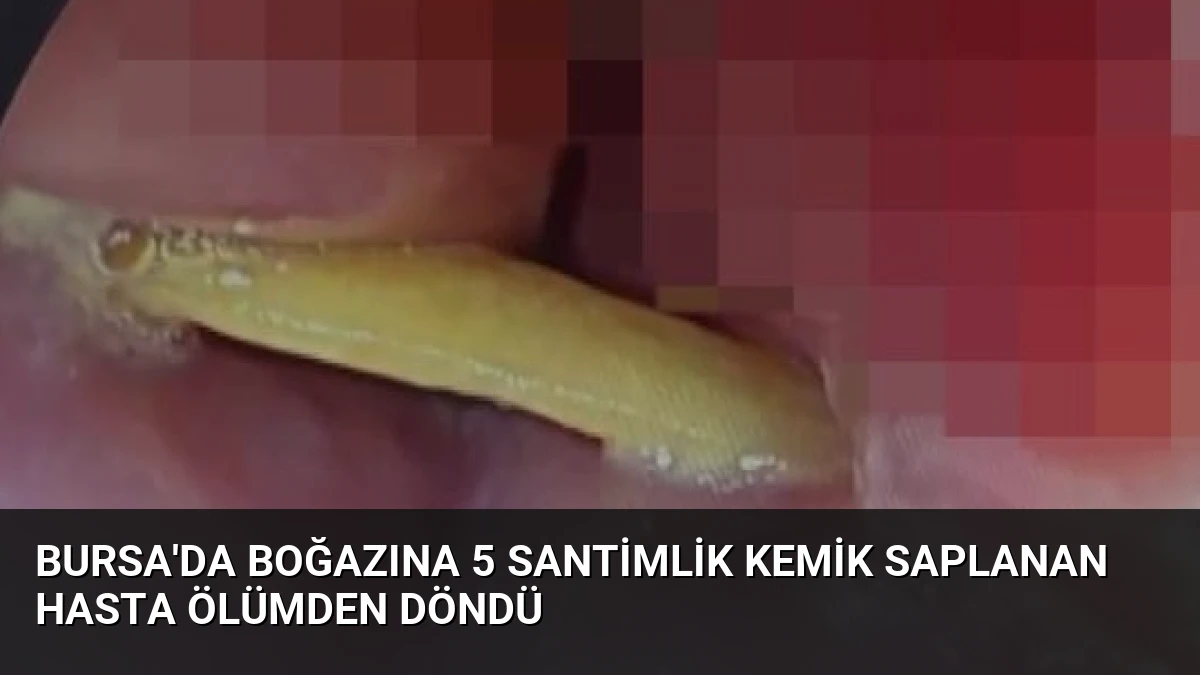 Bursa’da Boğazına 5 Santimlik Kemik Saplanan Hasta Ölümden Döndü